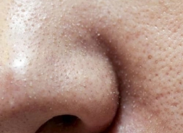 MỤN CÁM LÀ GÌ? NGUYÊN NHÂN VÀ CÁCH TRỊ MỤN CÁM HIỆU QUẢ NHẤT?