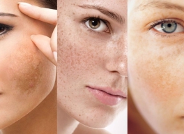 NÁM CHÂN SÂU LÀ GÌ? NGUYÊN NHÂN, DẤU HIỆU VÀ CÁC ĐIỀU TRỊ HIỆU QUẢ