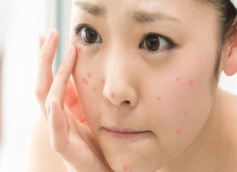 NẶN MỤN XONG CÓ NÊN ĐẮP MẶT NẠ? NHỮNG LƯU Ý CẦN LÀM SAU KHI NẶN MỤN.