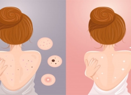 CÁCH TRỊ MỤN LƯNG TẠI NHÀ HIỆU QUẢ