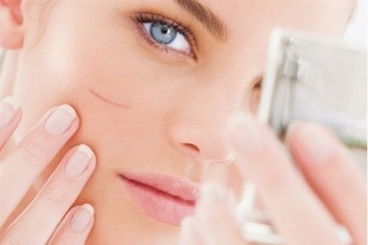 NHỮNG CÁCH LÀM MỜ SẸO THÂM HIỆU QUẢ ÍT AI BIẾT