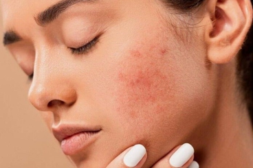 LOẠI VITAMIN NÀO TỐT CHO DA MỤN?