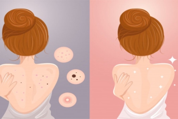 CÁCH TRỊ MỤN LƯNG TẠI NHÀ HIỆU QUẢ