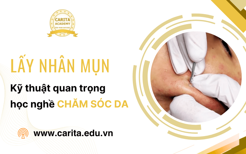 lấy nhân mụn
